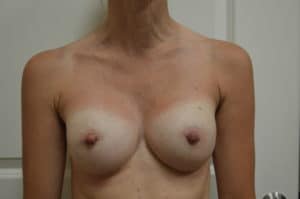 breast aug after breast aug after