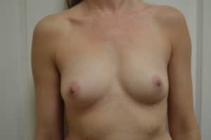 breast aug before breast aug before