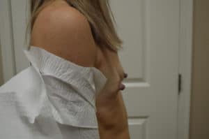 breast aug before (side) breast aug before (side)
