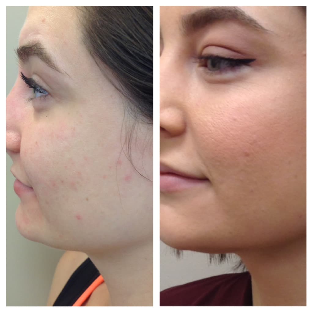 Kybella Before and After 3 Kybella Before and After 3