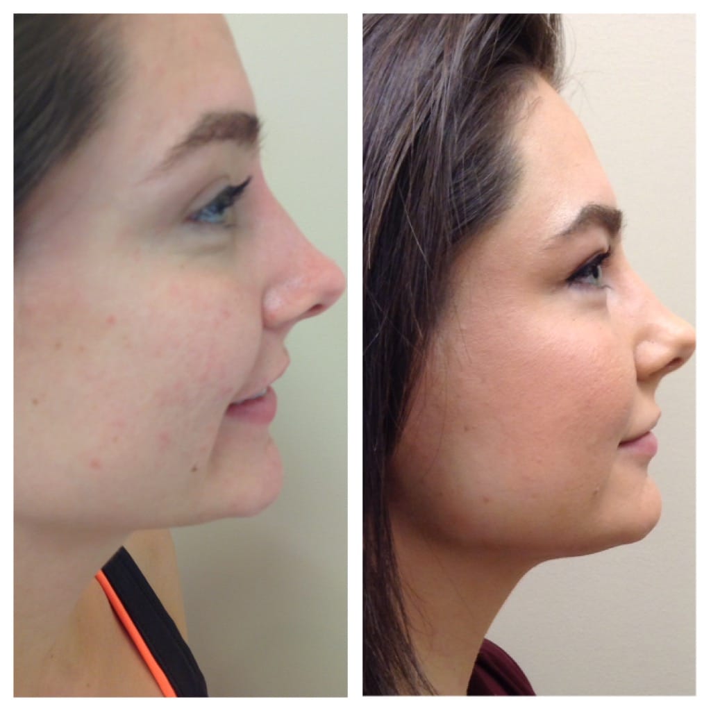 kybella before and after photos 3 Krummen Plastic Surgery