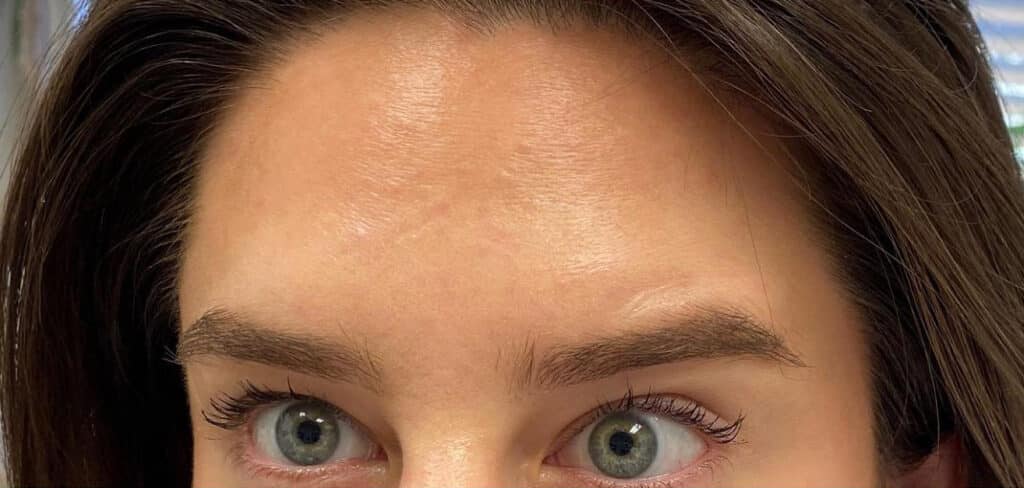 After Image: Botox – Case 1 - front
