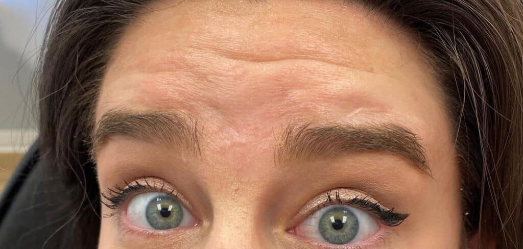 Before Image: Botox – Case 1 - front