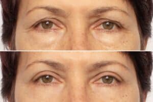 Upper, Lower, or Both? Types of Eyelid Surgery in Cincinnati, OH