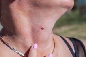 Close up of a woman pointing to the mole on her neck, in need of CryoCorrect™ to remove it.